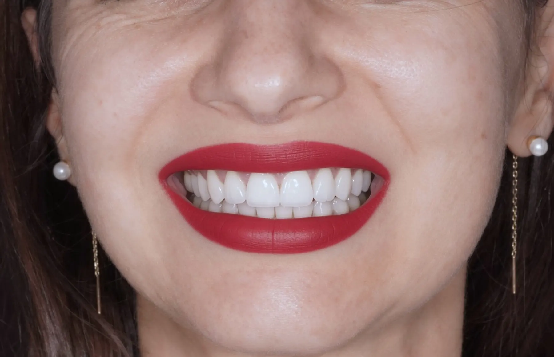 Rezultatul după tratament — estetică dentară, comparația 1