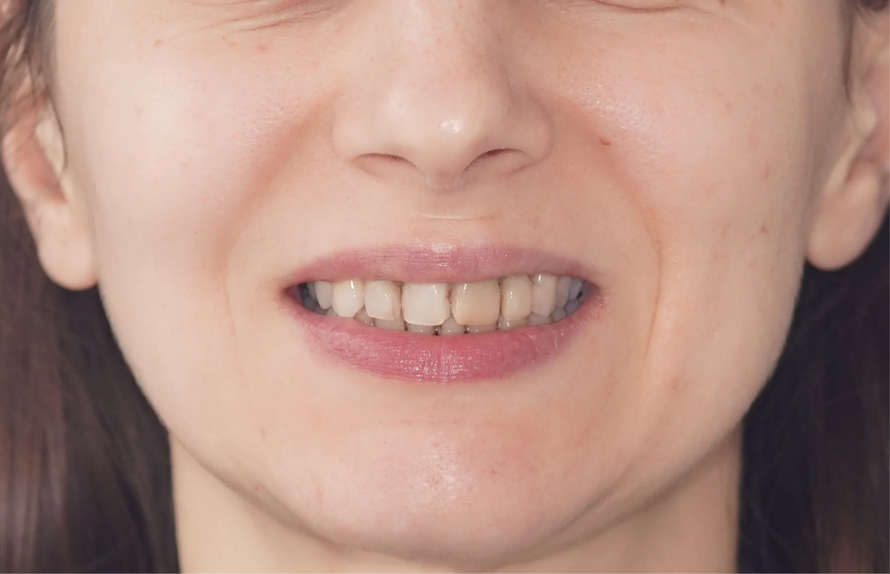 Situația înainte de tratament — estetică dentară, comparația 1
