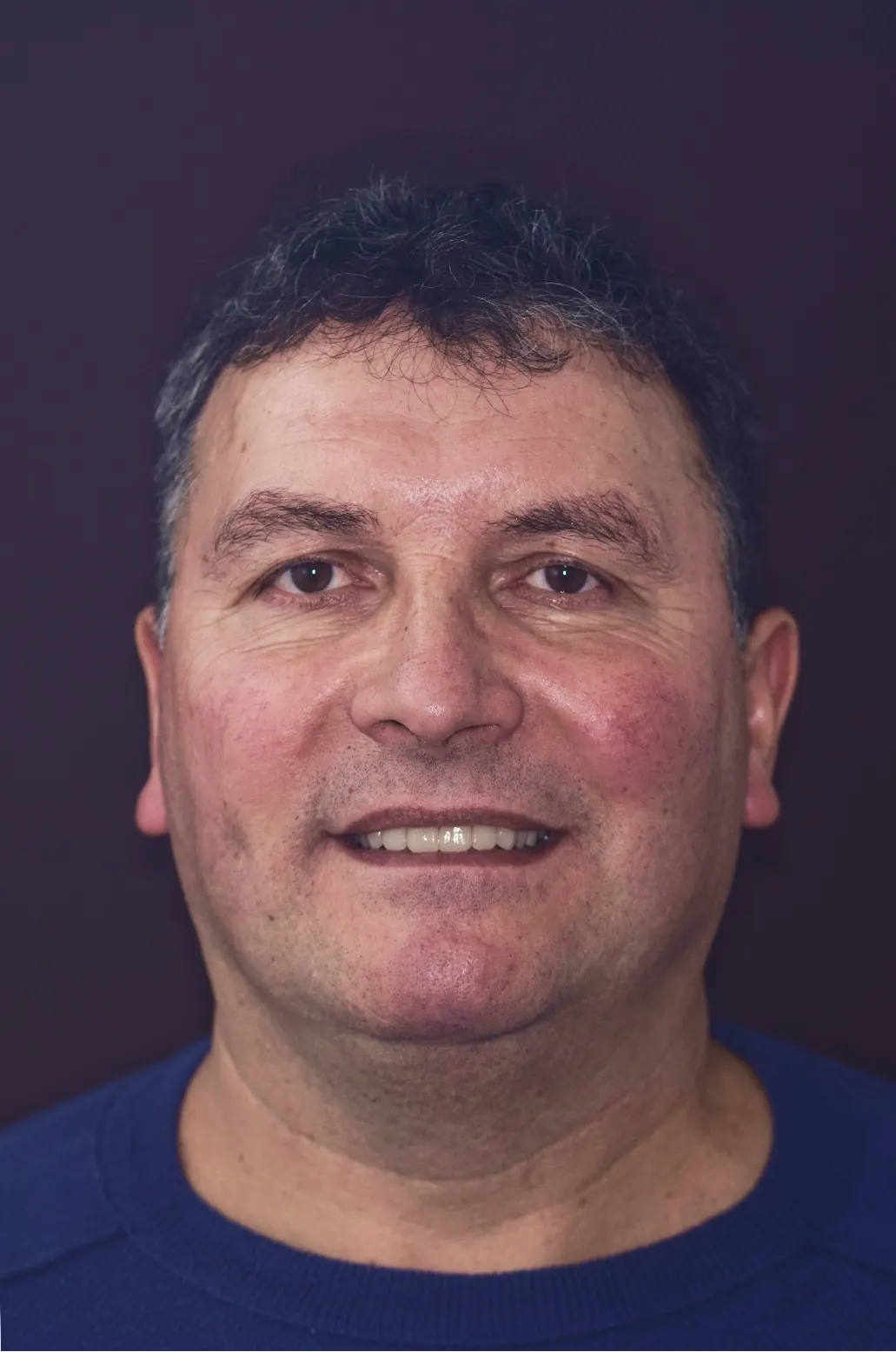 Rezultatul după tratament — estetică dentară, comparația 1
