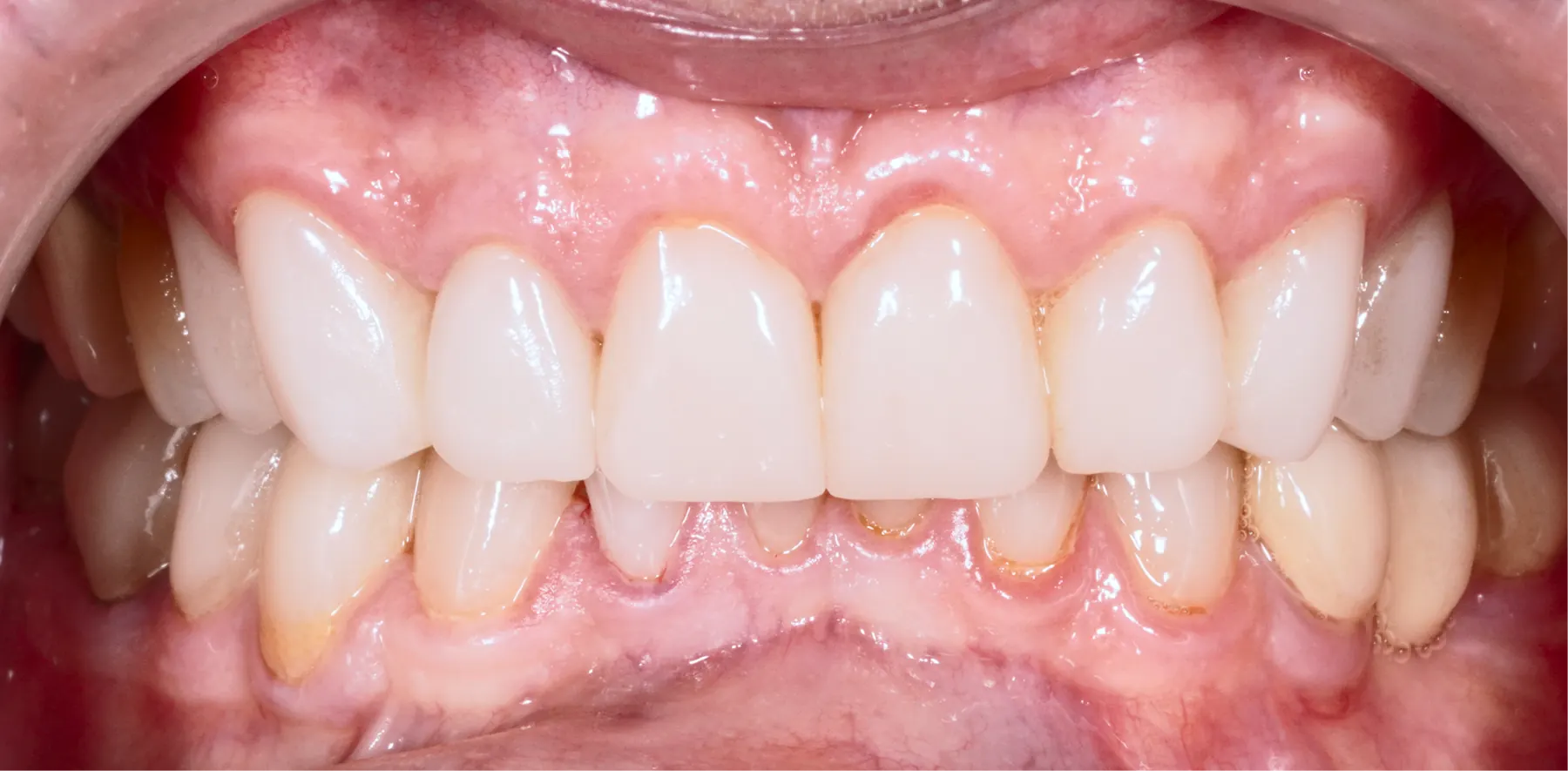 Rezultatul după tratament — estetică dentară, comparația 1