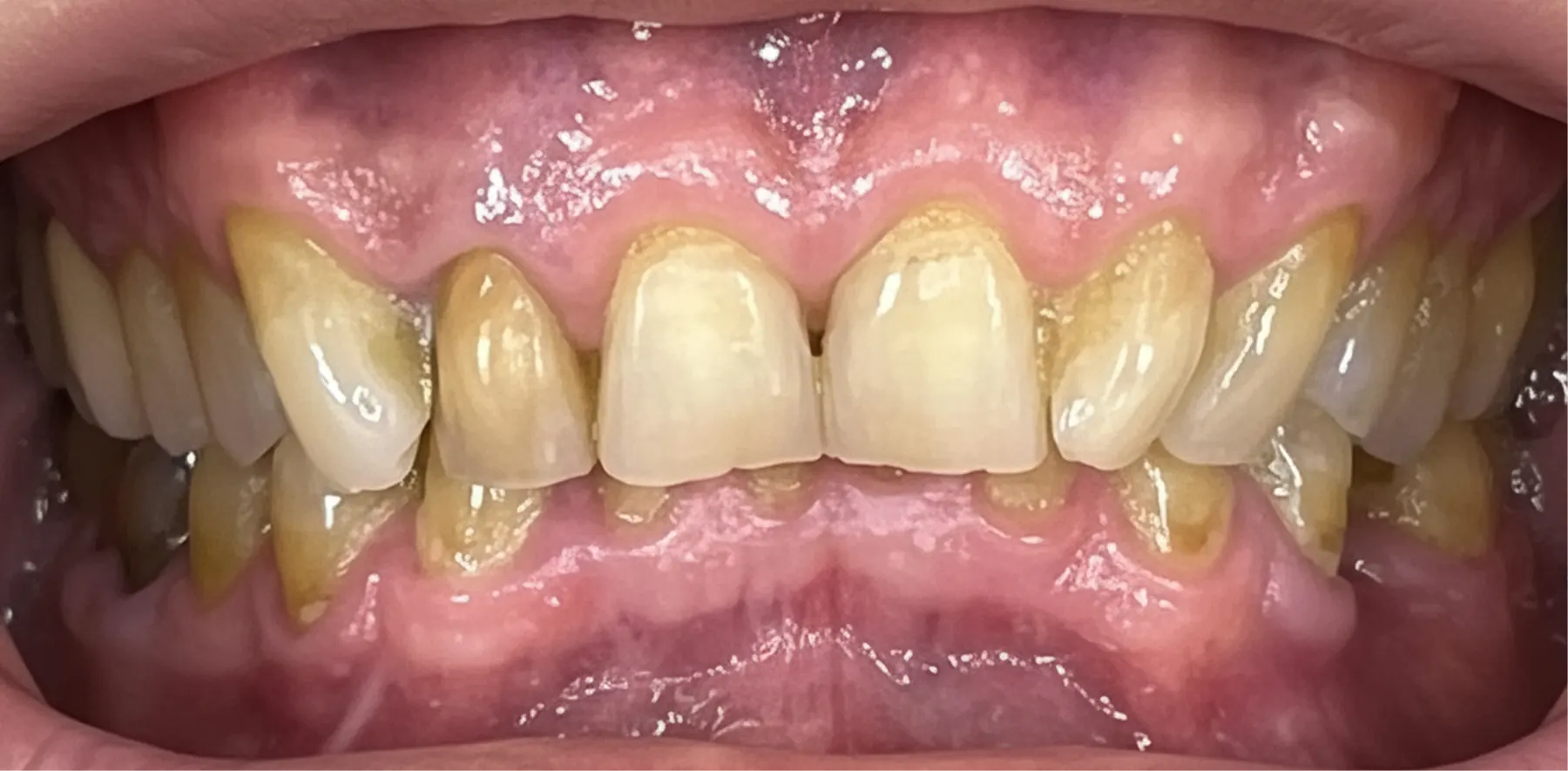 Situația înainte de tratament — estetică dentară, comparația 1