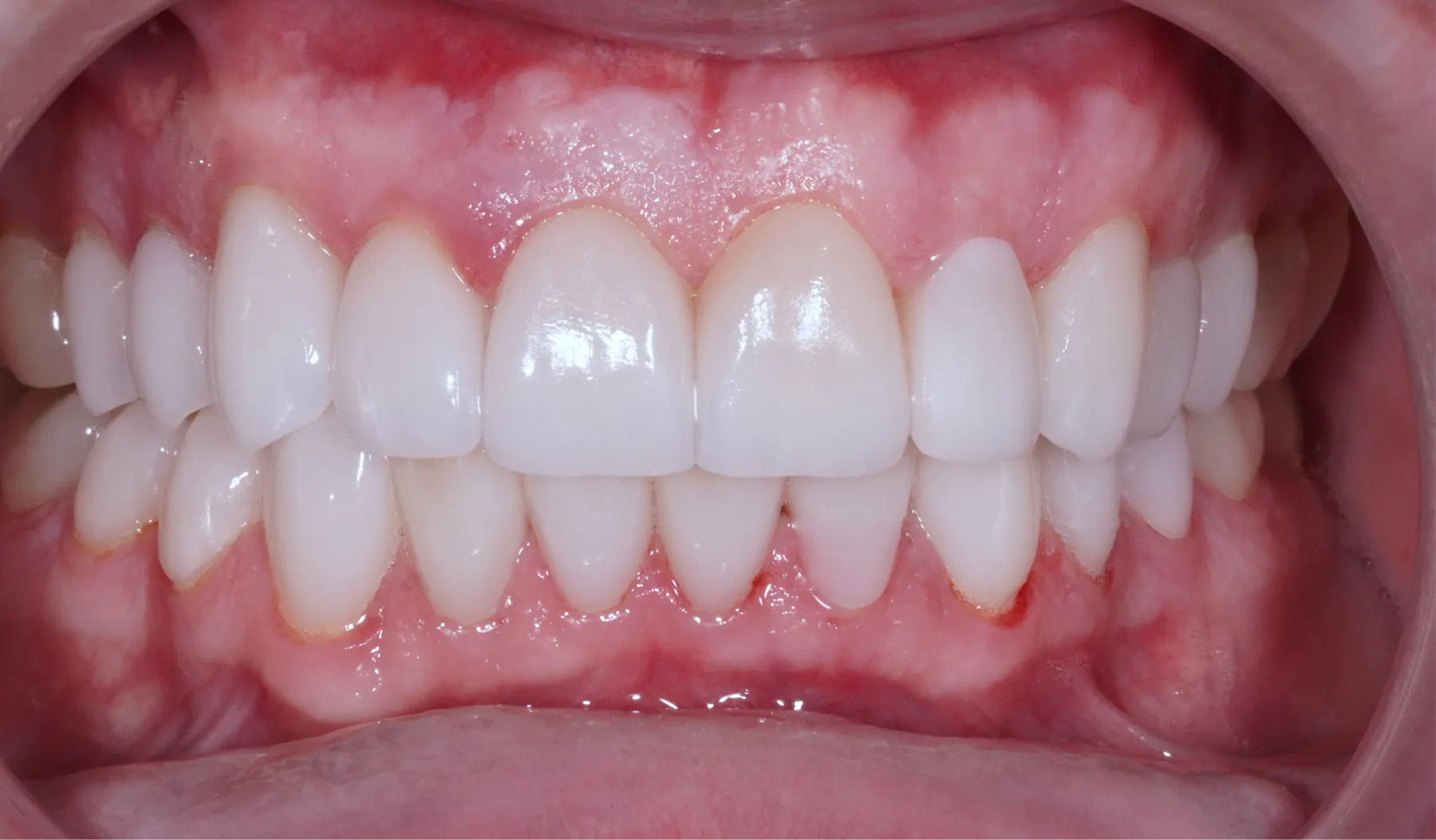 Rezultatul după tratament — estetică dentară, comparația 1