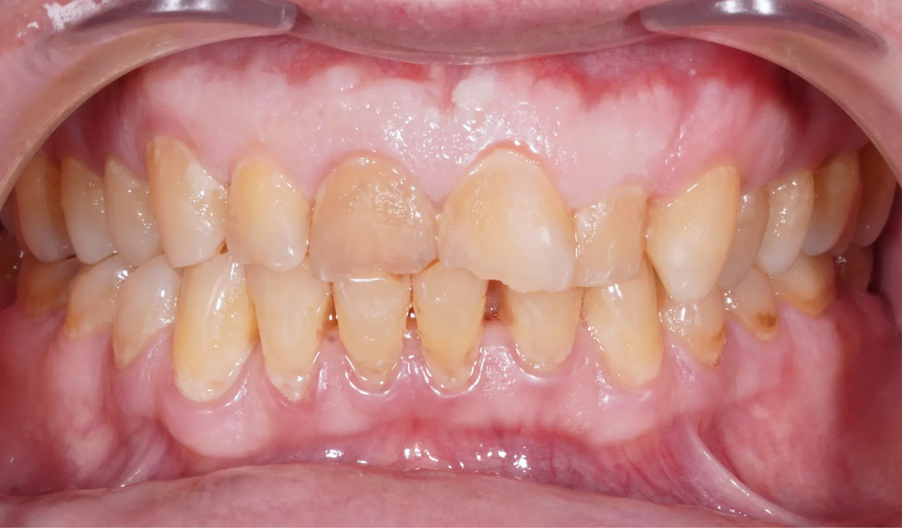Situația înainte de tratament — estetică dentară, comparația 1