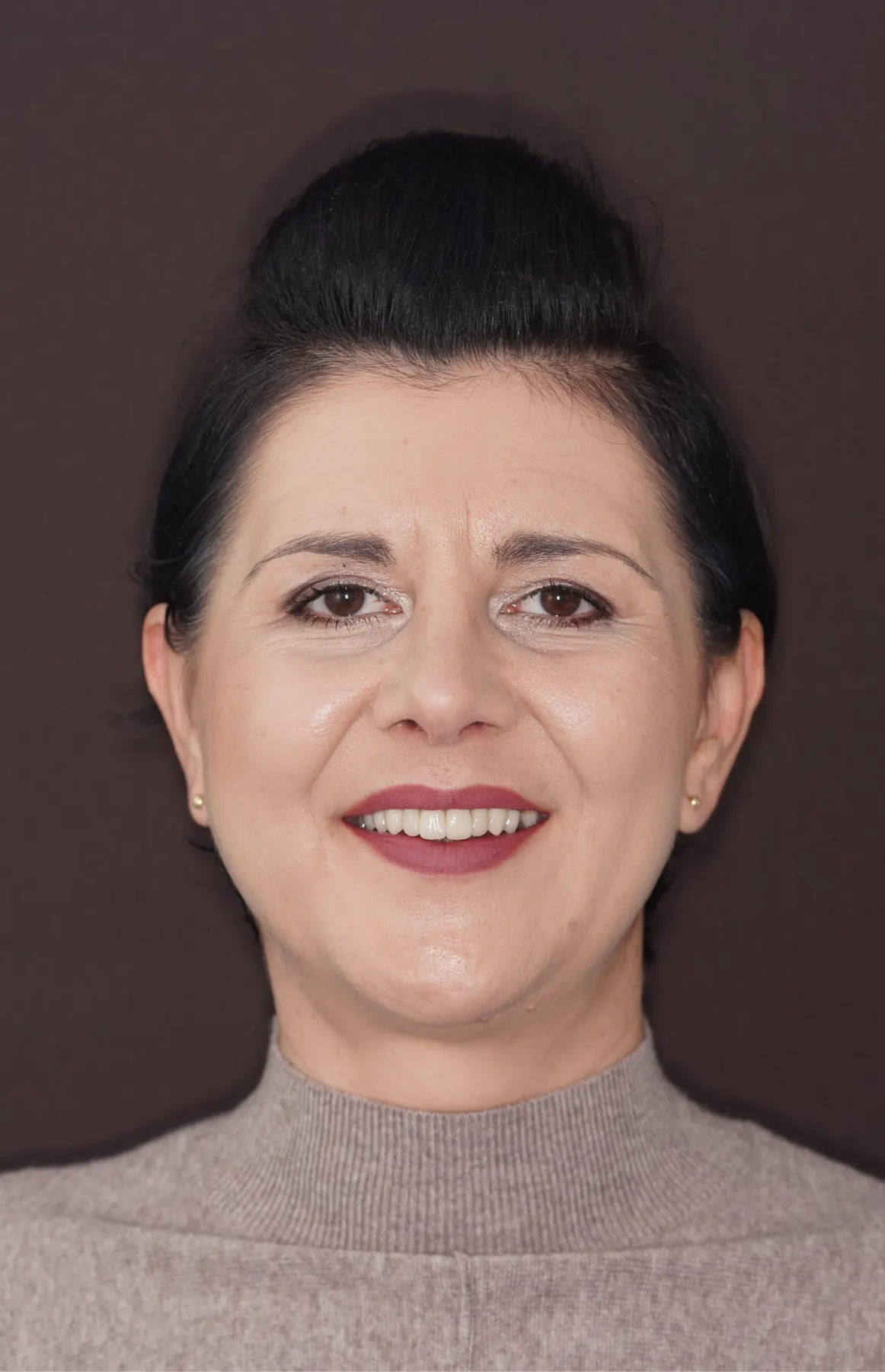 Rezultatul după tratament — caz dentar documentat, comparația 1