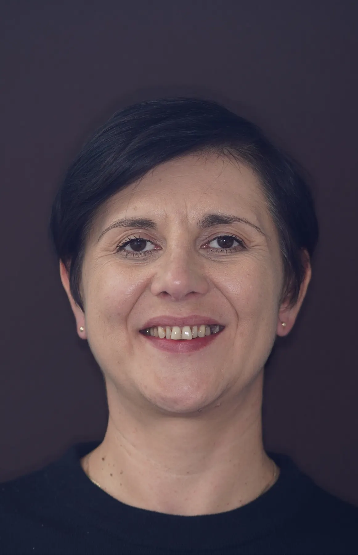 Situația înainte de tratament — caz dentar documentat, comparația 1