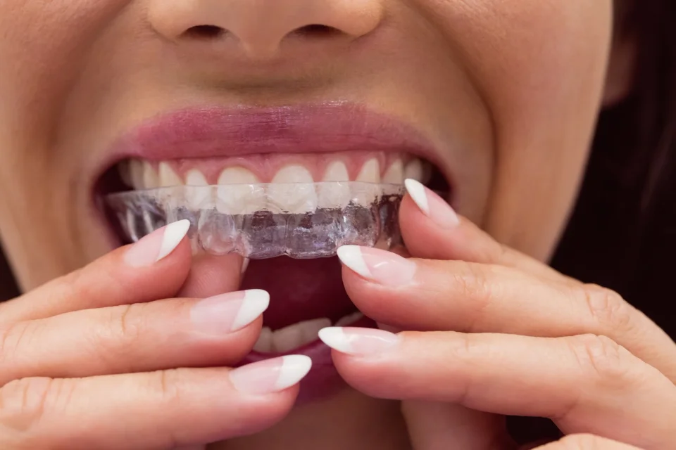 Aparat fix sau alignere transparente? Invisalign, Spark și criteriile de alegere