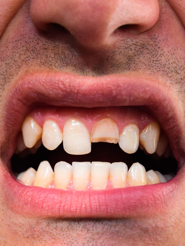 Dinte fisurat după traumatism dentar